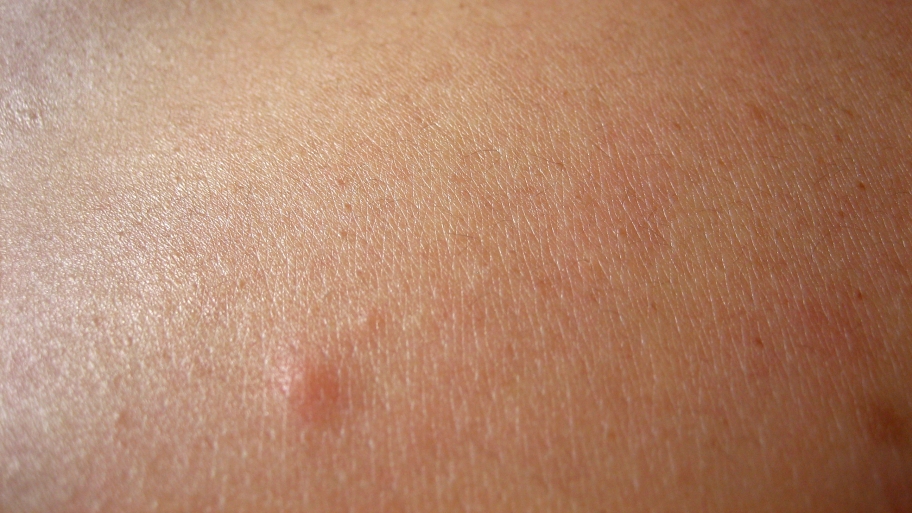 skin cancer freckles skin cancer freckles